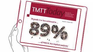 Find out  about the Edwards tricuspid regurgitation valve therapies  | TMTT Today Video