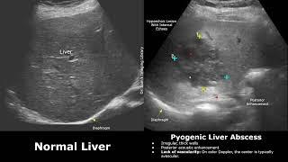Liver Ultrasound Normal Vs Hepatic Abscess Imaging Findings | Causes, Lab Findings & USG Features