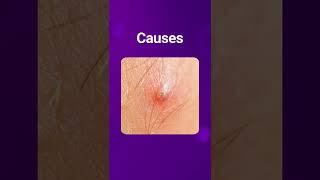 Is It Normal To Have Pimples Down There | Vaginal Acne | SoulFactors #shorts