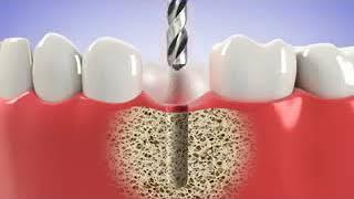 Dental Implants Placement Procedure