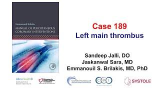 Case 189: Manual of PCI - Left main thrombus
