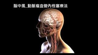 腦中風治療-動脈瘤血管內栓塞療法與顱內動脈取栓術