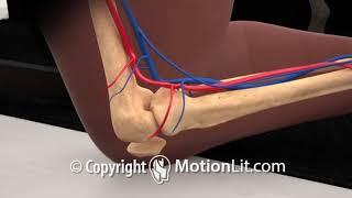 Knee Injury Popliteal Artery Laceration - MotionLit Animation