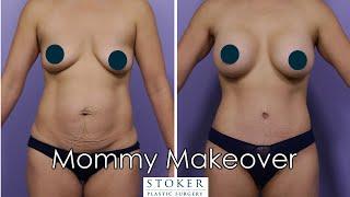 Mommy Makeover Los Angeles - Plastic Surgeon Dr. David Stoker Completes Patient's Transformation
