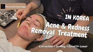 Acne and Redness Removal Treatment in Korea