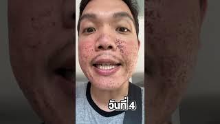 เลเซอร์ Pico หน้าใสสุดฮิต!!! ลดหลุมสิว