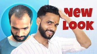 Hair Loss Breakthrough!  Best Hair Transformation in Vashi | New Roots