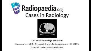 Left atrial appendage aneurysm (Radiopaedia.org) Cases in Radiology