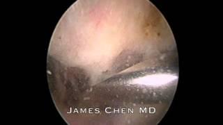 Arthroscopic Subacromial Decompression with Burr