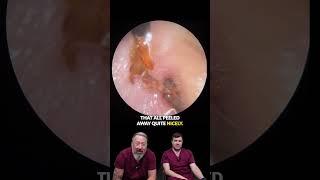 Oil Transforms Everything!  Watch This Eardrum Peel!