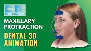 Maxillary Protraction Animation | reverse pull headgear before and after