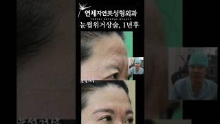눈썹위거상술과 이마축소술 #미간주름교정 #눈썹거상 #신촌성형외과  #연세자연미성형외과 #홍대성형외과 #눈썹위거상잘하는곳  #미간주름잘하는곳 #suprabrowexcision