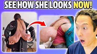 She Got Her MASSIVE Back Tumor Removed! Extreme Bodies Explained!