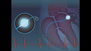 Cryoablation or Drug Therapy for Atrial Fibrillation | NEJM