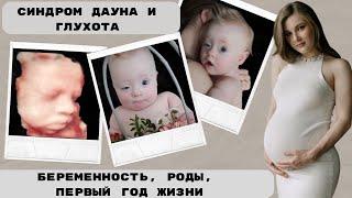 Рождение малыша с синдромом Дауна и глухотой. Беременность. Роды. Начало пути
