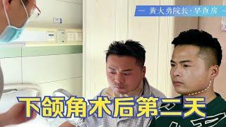 [黄大勇改脸型]男士下颌角术后第2天~