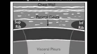 Ultrasound Guidance for Thoracentesis - Sonosite