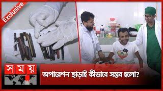 পেট থেকে বের হলো ১৫টি কলম! | Sirajganj 15 Pen | Somoy TV