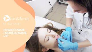 Powiększanie i modelowanie ust za pomocą JUVEDERM® ULTRA SMILE | Klinika VESUNA