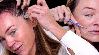 EDITED Live: Scalp Microneedling with Exosomes for Hair Growth! Watch the Process!