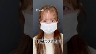 18歳のプチ整形 #二重整形 #二重埋没 #埋没 #目元整形 #ルラ美容クリニック #ルラ美容クリニック名古屋本院#名古屋美容クリニック