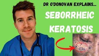 Explaining Seborrheic Keratosis | With Dr O'Donovan