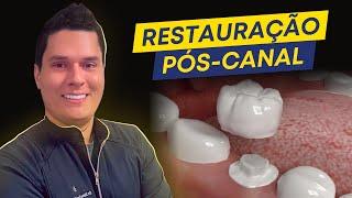 Restauracao de dente após canal : qual a melhor opção?