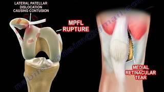 Basic Anatomy Of The Patella - Everything You Need To Know - Dr. Nabil Ebraheim