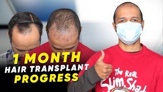 Hair Transplant in Panipat | Best Results & Cost of Hair Transplant in Panipat