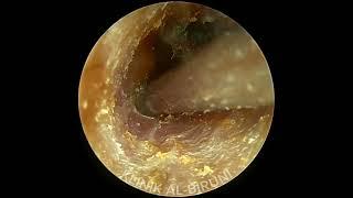 耳掃除】左だけイヤホンの音が聞こえにくくて～ earwax recommended by my wife 58