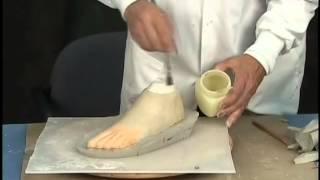 Custom Fabrication of A Silicone Partial Foot Prosthesis