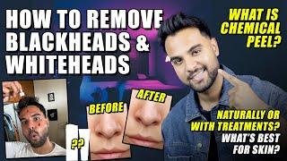 How to Remove Blackhead and Whiteheads at Home | Home Remedies for Blackheads & Whiteheads