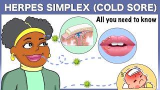 Herpes simplex (Cold sore): All you need to know