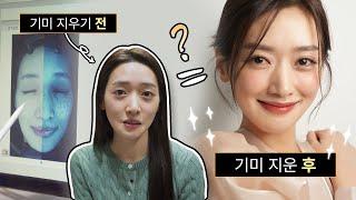 기미 패키지 2회로 기미 없앤 후기?! 레이저 후 변화 공개! | 시술 v-log