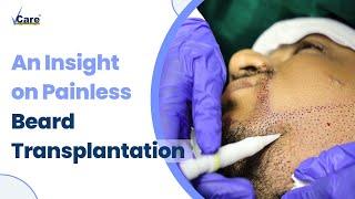 Struggling with a patchy beard? | Treat it with a painless Beard Transplantation