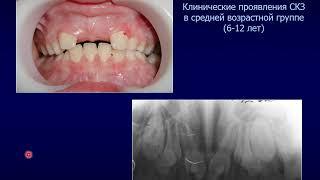 РЕТИНИРОВАННЫЕ И СВЕРХКОМПЛЕКТНЫЕ ЗУБЫ У ДЕТЕЙ