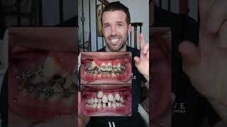 Can you spot it?? #braces #missingteeth