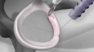 Knotless Shoulder Labral Repair with Arthrex® PushLock®