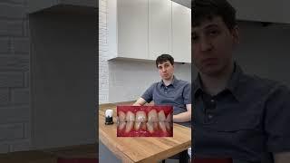 В чем отличие пародонтита от пародонтоза?