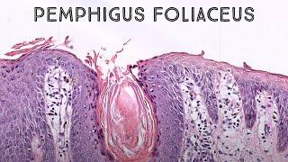 Pemphigus foliaceus (autoimmune skin blister immunobullous disease in pemphigus vulgaris family)