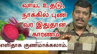 வாய் புண் , உதடு மற்றும் நாக்கு புண் வர காரணம் இதுதான் எளிதில் குணம் செய்யலாம்- Healer Baskar