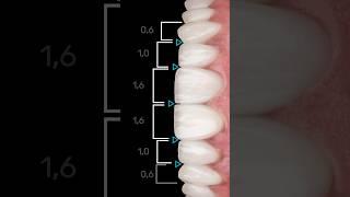 Emax veneers for a Perfect Smile Transformation