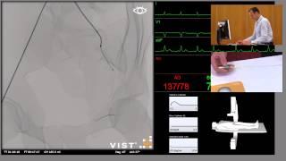 Mentice VIST®-C - Uterine Artery Angiogram