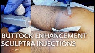 Male Buttock Enhancement with Sculptra Injections | LIVE