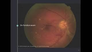 The Eye and Diabetes Mellitus