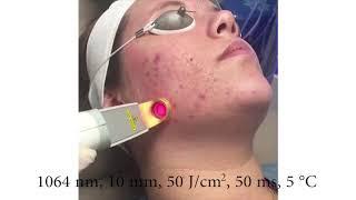 Cutera Excel V Acne Treatment - Effectively Remove Acne & Acne Scarring!