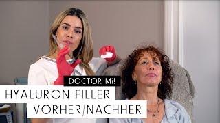 Hyaluron Filler Vorher / Nachher | DOCTOR MI! Folge 9
