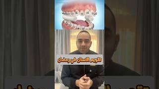 اعرف ازاي تتعامل مع تقويم الاسنان في رمضان  حاجات لازم تعملها علشان تحافظ على التقويم وعلى اسنانك