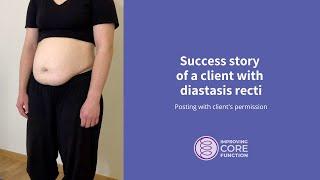 Success story of a client with diastasis recti