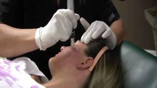 Skin Rejuvenation Facial Treatment using Dermapen | Dr. Johnsen